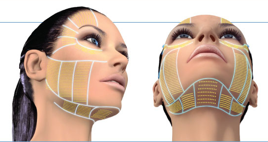 HIFU tác dụng lên nhiều vùng trên mặt giúp nâng đỡ các cơ, căng da và trẻ hóa.